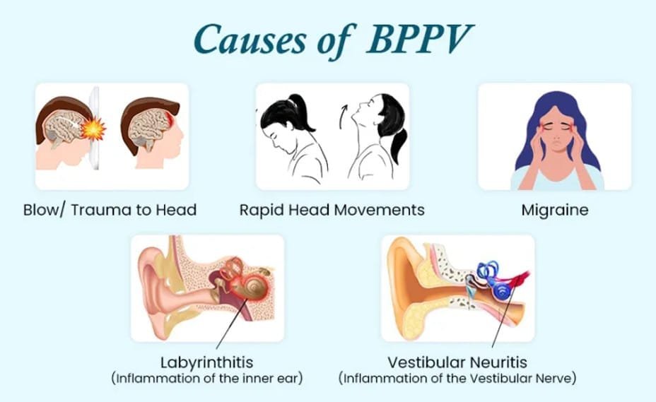 Benign Paroxysmal Positional Vertigo (BPPV) | Akdeniz Vertigo Center